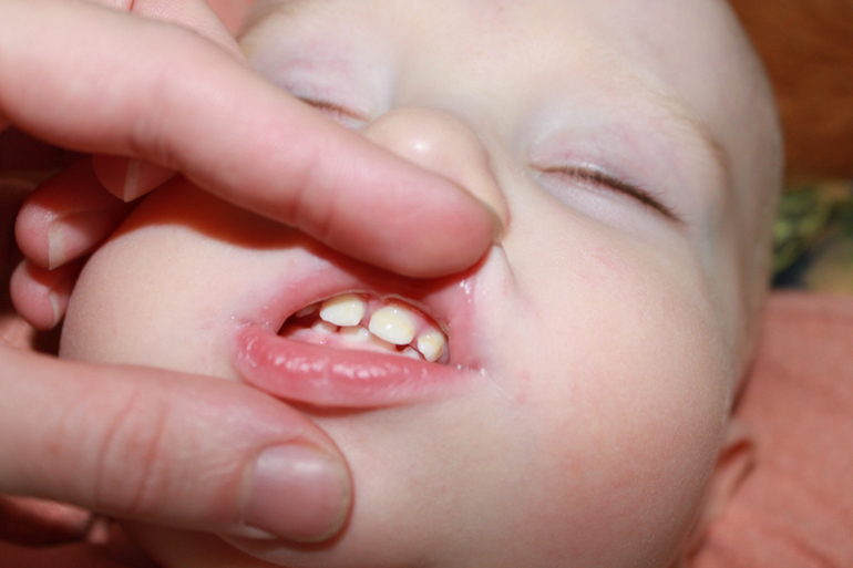 Лечение зубиков у 11 мес. малыша