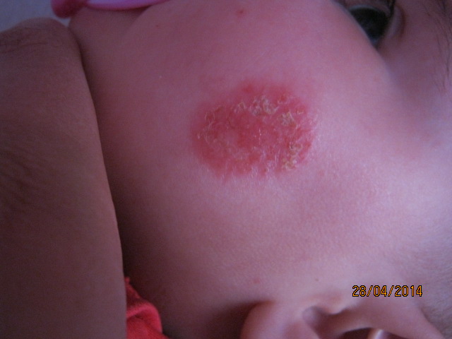 Пятно на щечке.