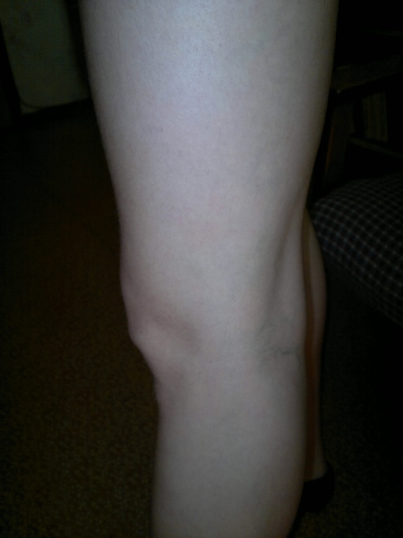 продолжение варикозной паранои.) фотки. ничего нового не увидите...