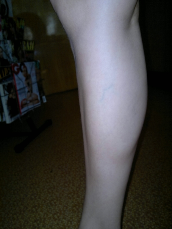 продолжение варикозной паранои.) фотки. ничего нового не увидите...