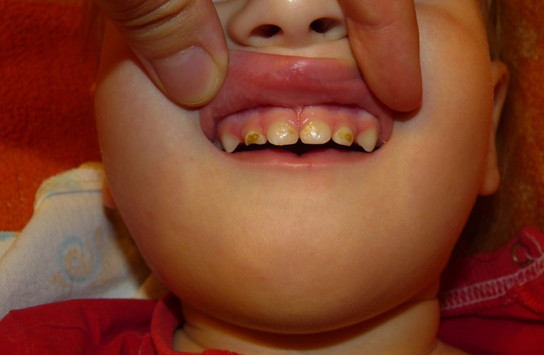 Что у нас и как это лечить? нам 1год 11мес