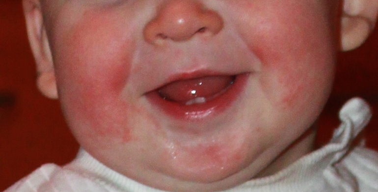 Красные щечки у малыша: стоит ли волноваться? | MUSTELA