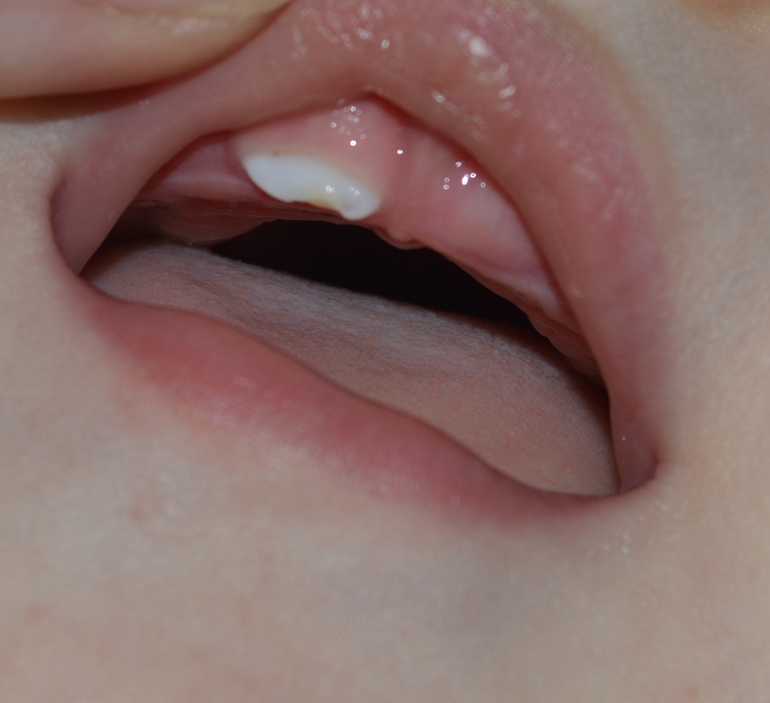 Отломился зубик...