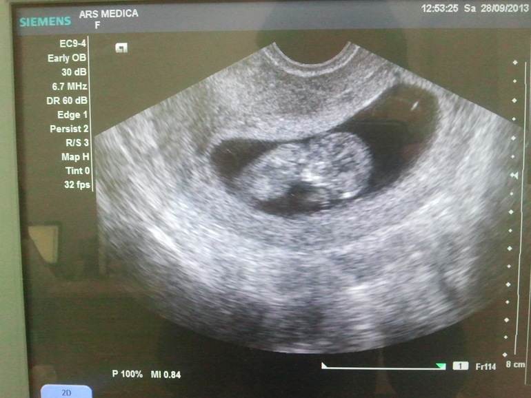 Ровно 11 неделек. УЗИ (дополнительно перед скринингом)