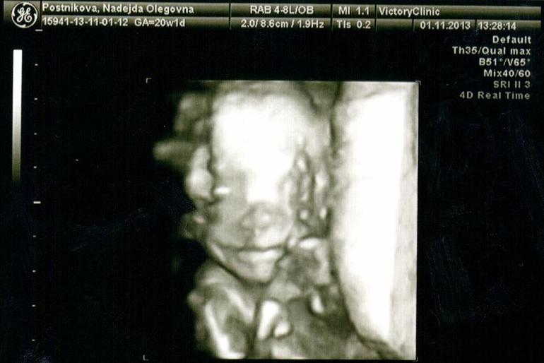 20 недель (Наш экватор + 2 плановое УЗИ)