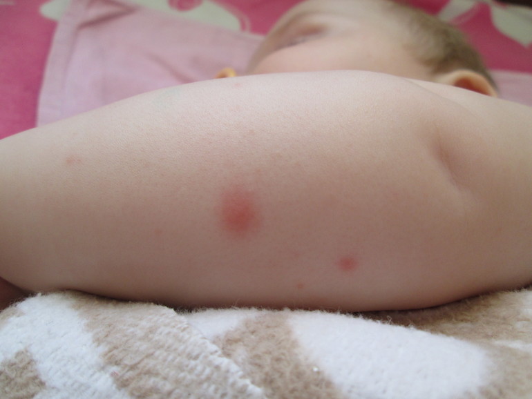 Укусы насекомых у детей: профилактика и лечение | Клиника Рассвет