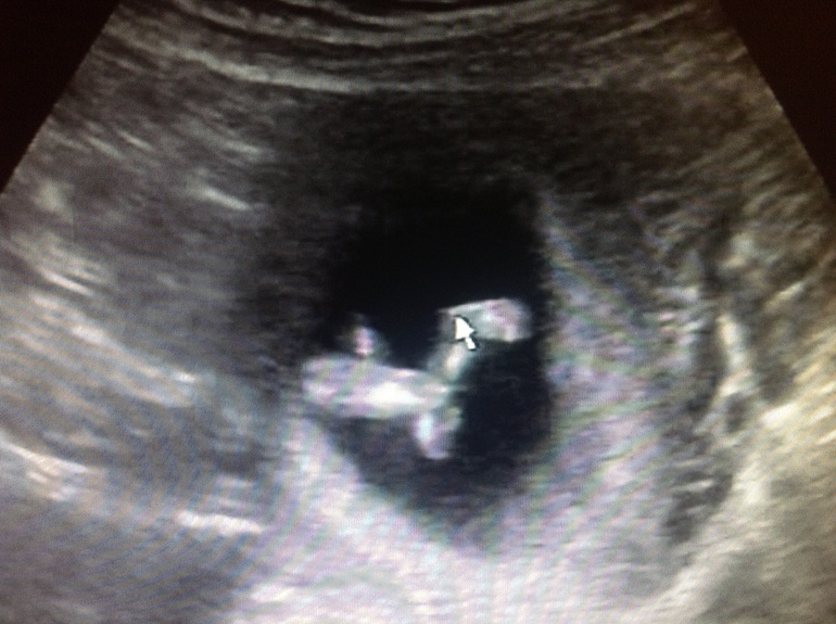 Прошли мы первый скрининг!!!!! У нас все хорошо!!! Тттттттт!!!!!