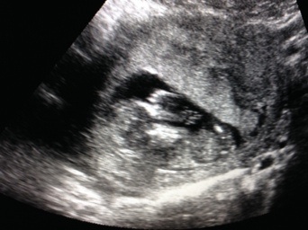 Наконец-то! Наше узи в 12 недель:)