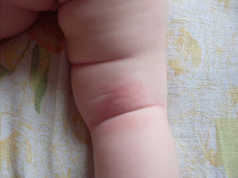 Краснота на коже