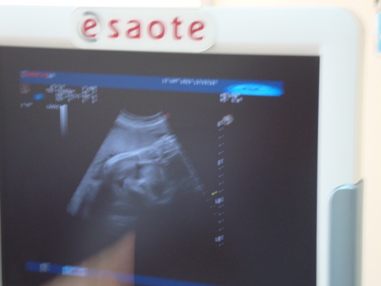 УЗИ на 31 недельке