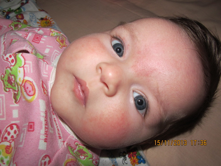 аллергия?????????????