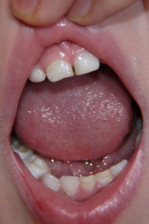 мнения стоматологов разделились!что же делать?