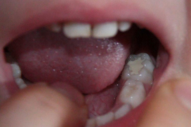 мнения стоматологов разделились!что же делать?