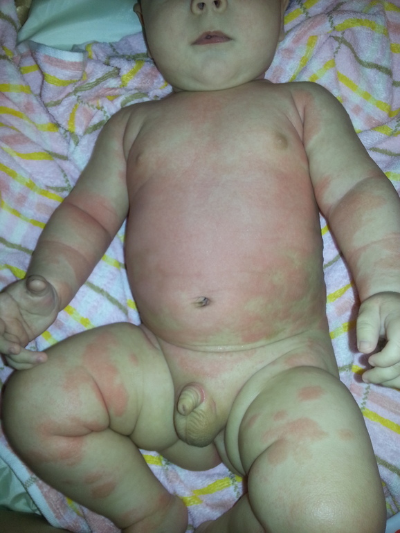 Атопический дерматит???