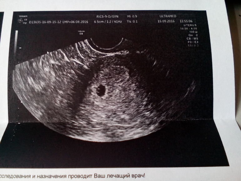 6 недель в россии. Плод на 6 неделе беременности УЗИ. УЗИ 6 недель беременности гипертонус. Эмбрион 4 недели беременности по УЗИ. Эмбрион на 4 неделе беременности УЗИ.
