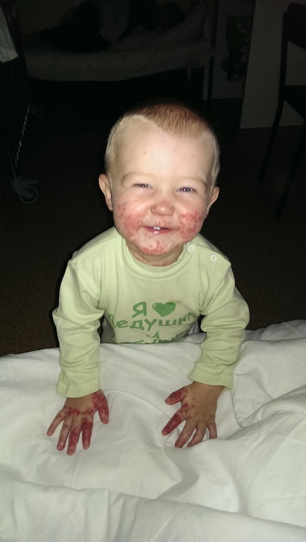 Атопический дерматит+ сыпь