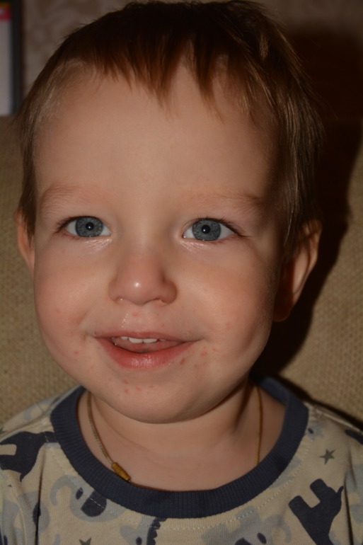 Что за прыщики?!