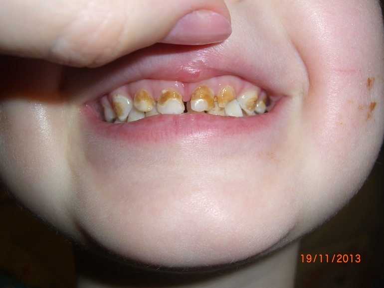 При корневой кариес в 3 года. Как лечить?