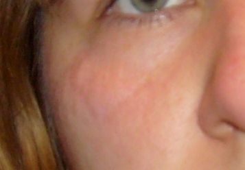 Аллергия. Что делать?