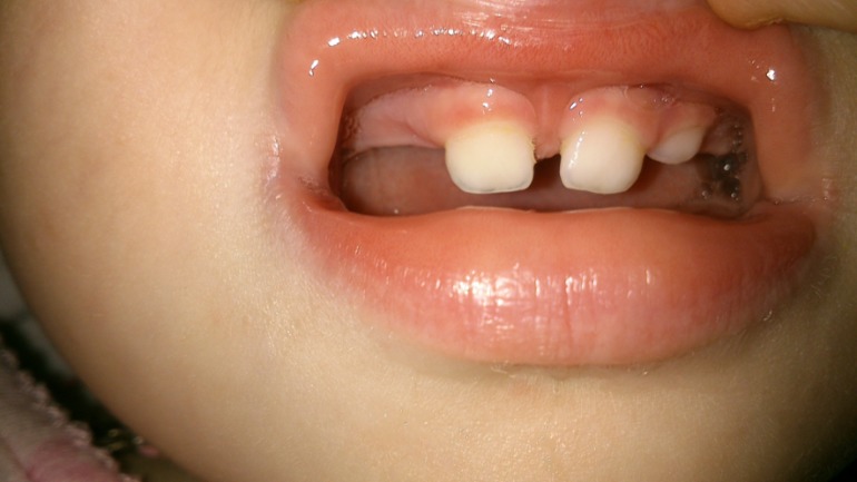 Налет на зубах