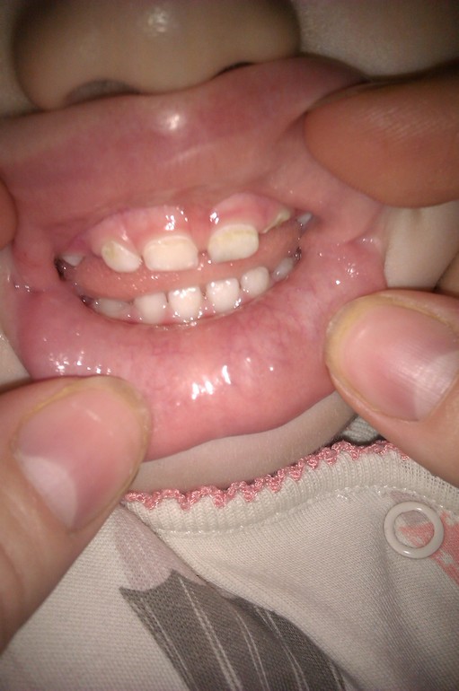 Разрушаются зубы.