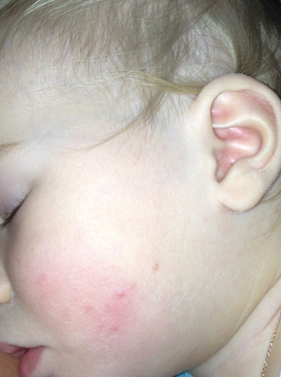 Подскажите, что за прыщи??