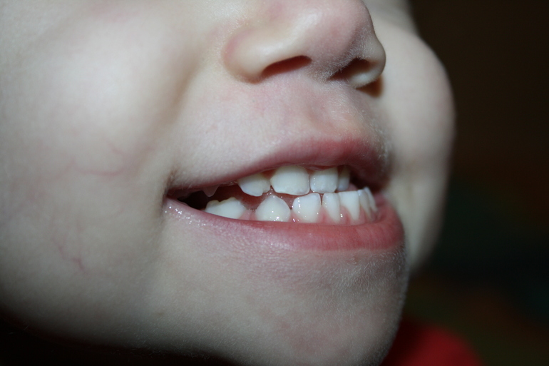 Скол на зубике. Как решить проблему?