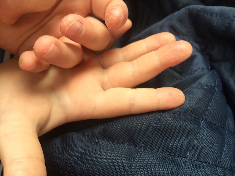 Трещины кожи рук и пальцев – лечение в Кривом Роге