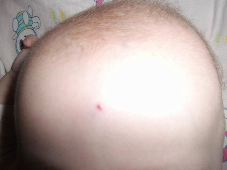 Гемангиома