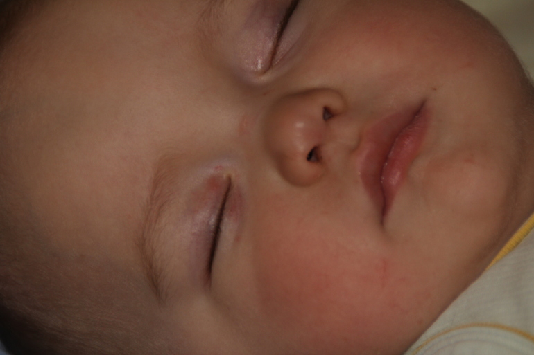 Псориаз? или что?