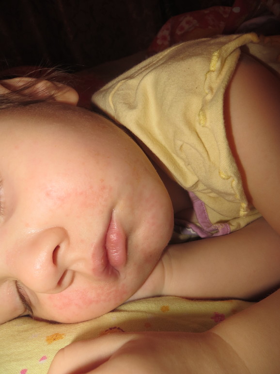 что это??аллергия???