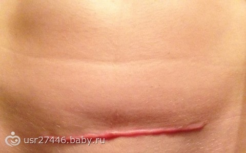 Шрам после КС