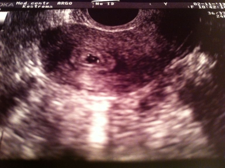 Возвращение Даши или как я забеременела!