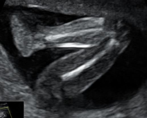 Стоп-кадры УЗИ (из видеоматериала)