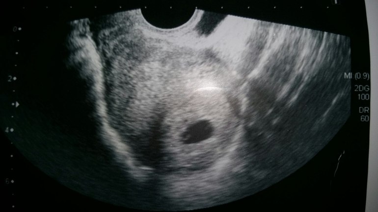Анэмбриония (не видно эмбриона) 5 неделя