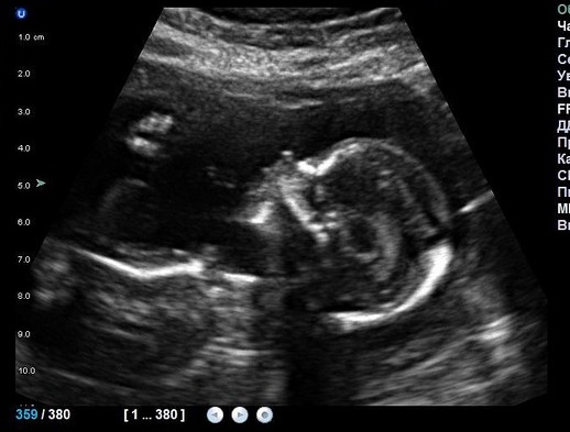 А мы сегодня 2-ой скрининг прошли