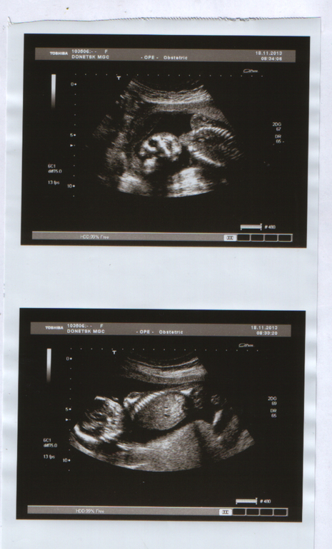 2 скрининг 17 недель и 6 дней)