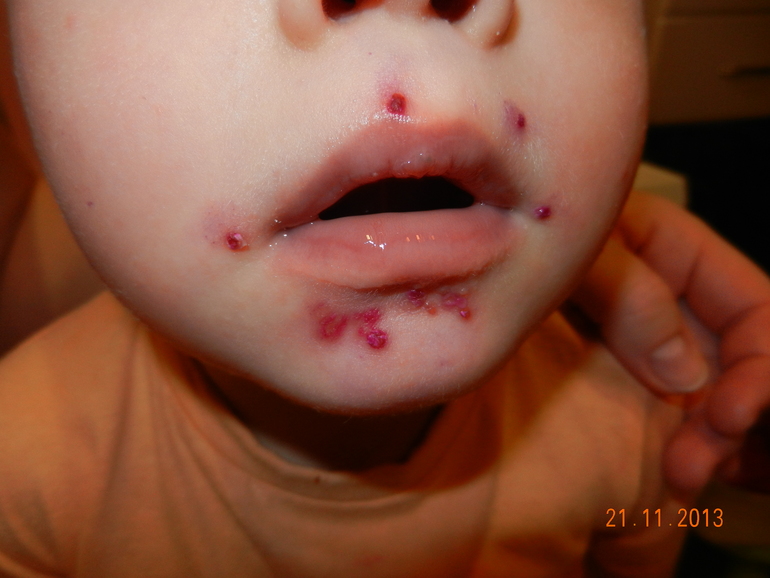 Стрептодермия..