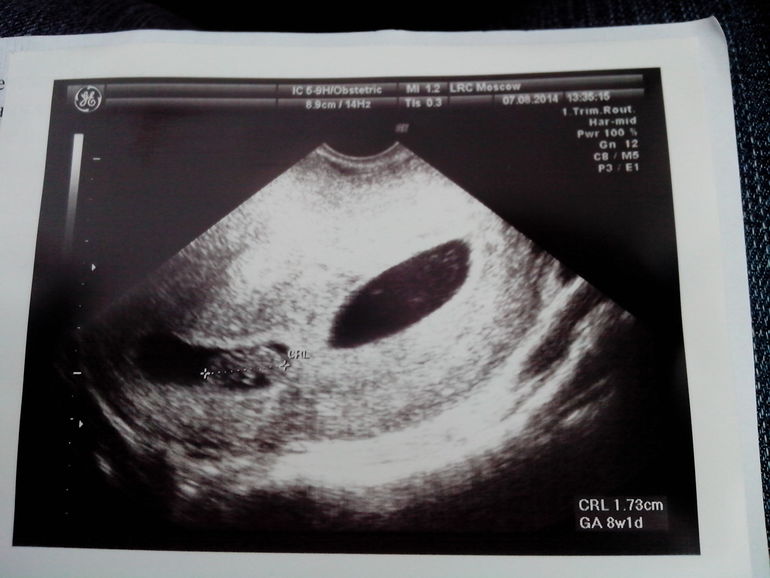Узи 7-8 недель беременности двойня. Бихориальная биамниотическая двойня. Типы сращения сиамских близнецов. Однояйцевая двойня. Моно моно беременность.