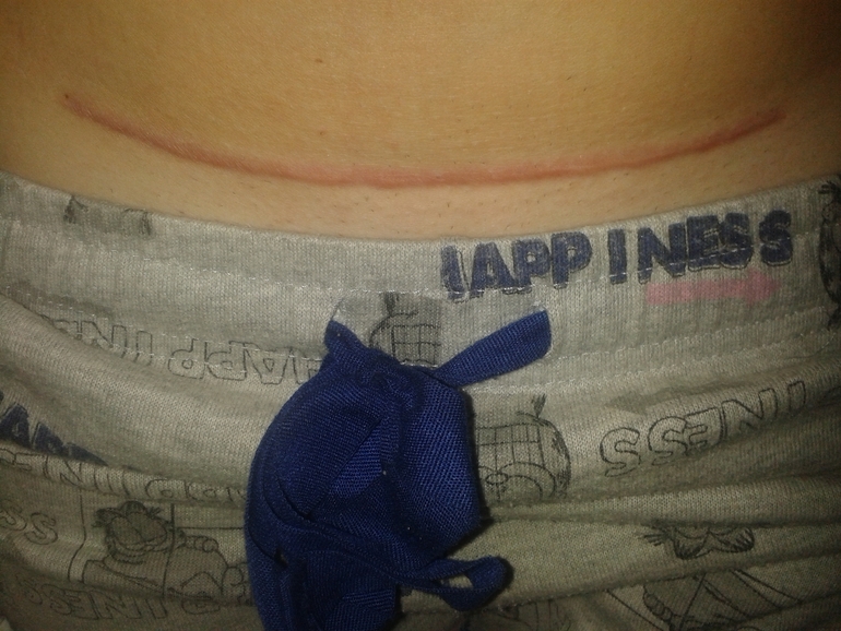 шов и его будущее!!!