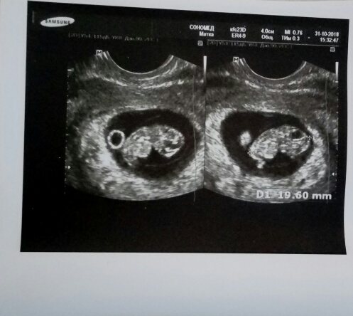 Фото узи двойни на 5 неделе беременности