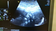 Фото УЗИ на 25 неделе беременности