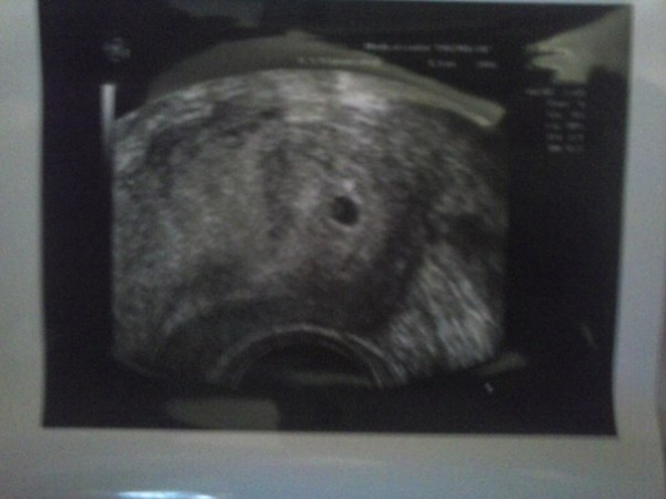 Снимок УЗИ на 4 неделе беременности на мониторе. Беременность 5 недель на мониторе УЗИ. Снимок УЗИ на 5 неделе на экране. Фото узи на 5 неделе