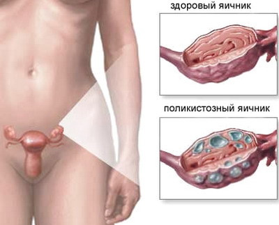 Поликистоз ???