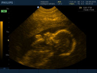 Фото УЗИ на 27 неделе беременности