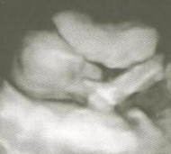 Фото УЗИ на 20 неделе беременности