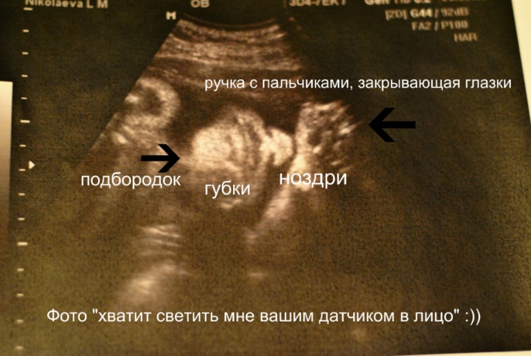 Узи 30 недель и 6 дней