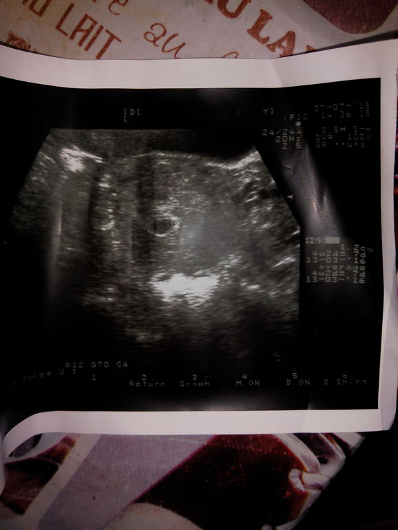 ХГЧ5.853....срок по мес.6 недель.4 дня,по узи 4.нед.и 2