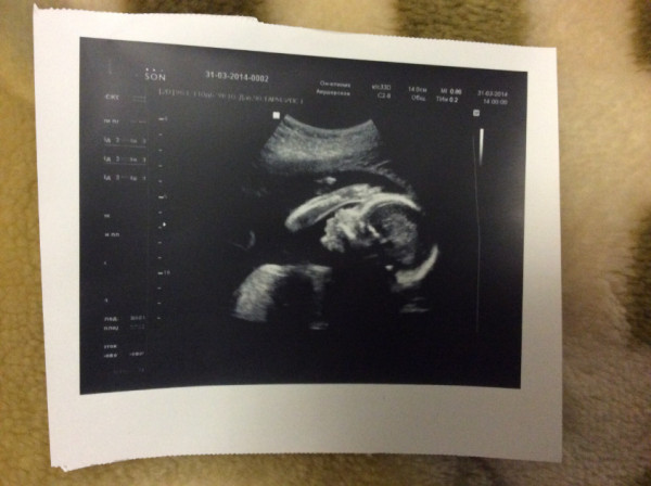 Фото узи 25 недель беременности девочка