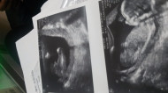 Фото УЗИ на 17 неделе беременности